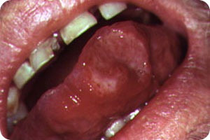 canker sores